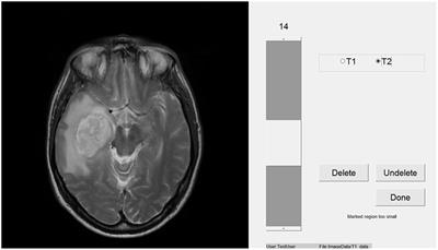 Expertise Affects Inter-Observer Agreement at Peripheral Locations within a Brain Tumor
